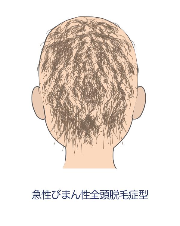 円形脱毛症_急性びまん性全頭脱毛症ADTA