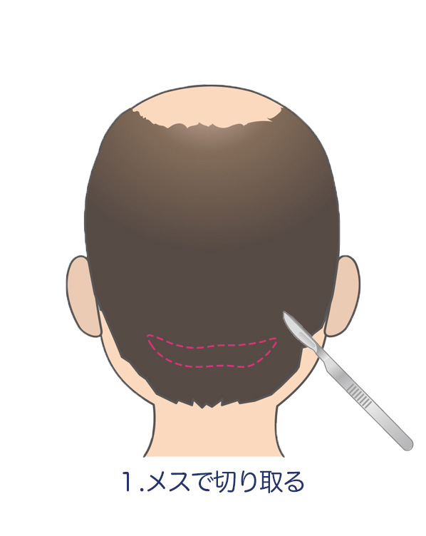 植毛_メスで切り取る