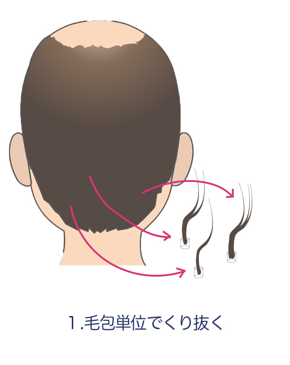 植毛_毛包単位でくり抜く